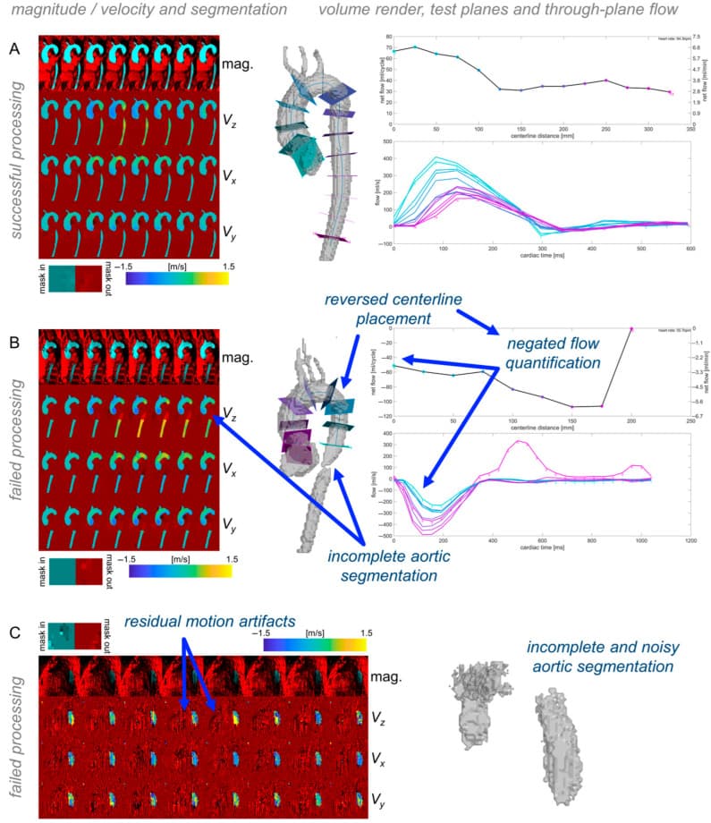 Deep-learning-enabled 4D flow MRI figure relevant to Bradley Allen's translational hemodynamics grant
