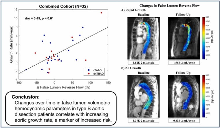 Aortic dissection 4D flow MRI figure relevant to automated false-lumen flow analysis