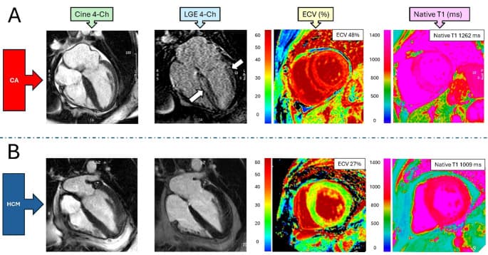 Representative multiparametric CMR images and maps from the cardiac amyloidosis study