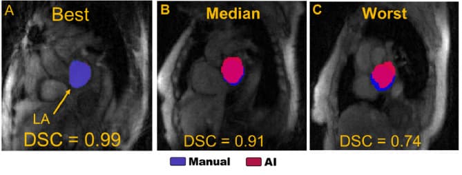 Atrial fibrillation flow MRI figure relevant to arrhythmia-resolved 5D flow MRI