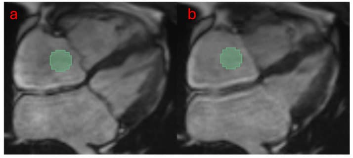 Cine MRI right atrial region-of-interest figure from the tricuspid regurgitation radiomics study