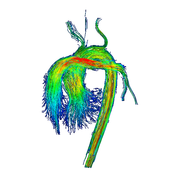 Color streamline rendering of cardiovascular 4D flow MRI.