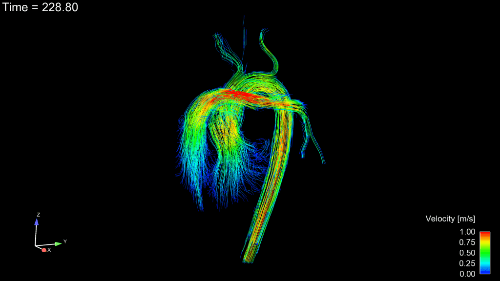 Congenital heart disease 4D flow streamline rendering relevant to respiration-resolved 5D flow MRI