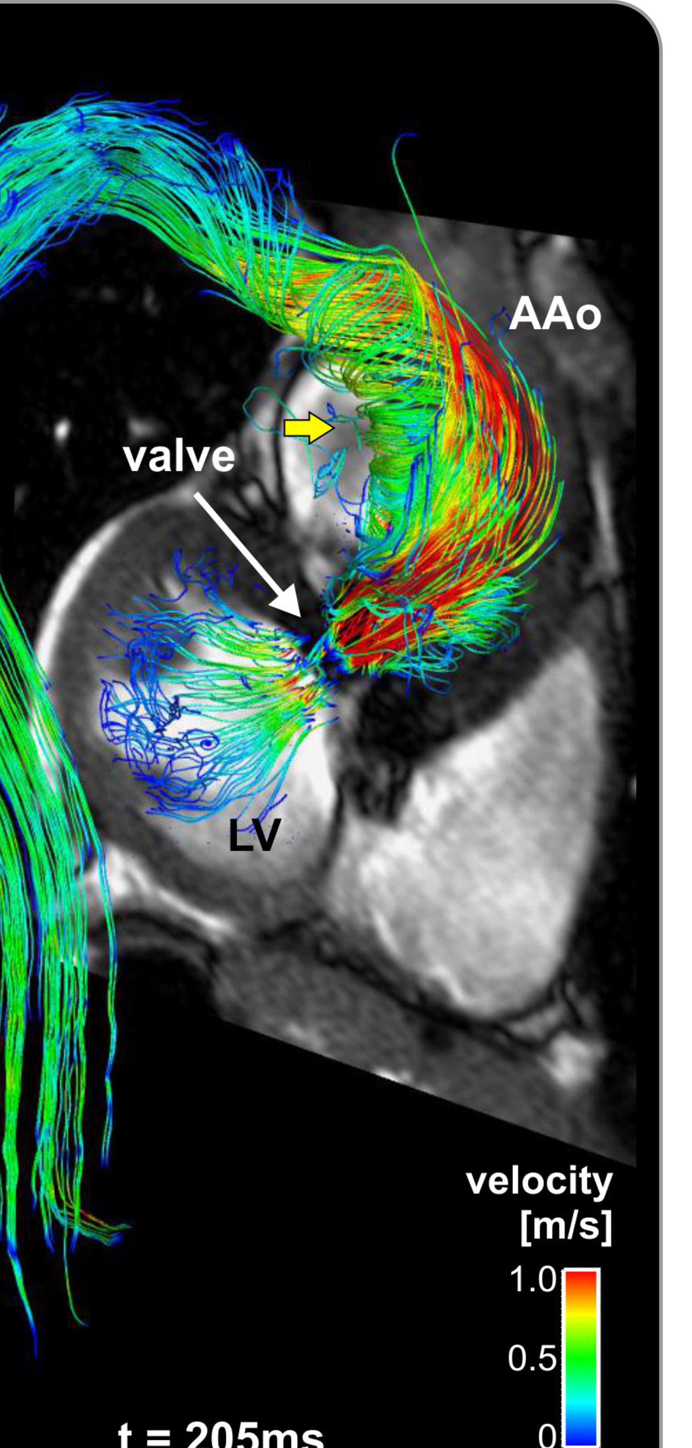 4D flow visualization representing AI-driven hemodynamic modeling.