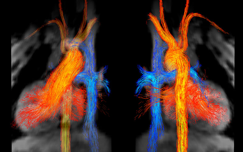 Orange and blue 4D flow MRI streamline visualization.