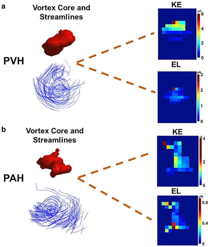 Pulmonary vortex-core and streamline figure.
