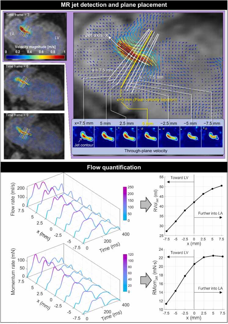 Open-access figure illustrating direct mitral-regurgitation flow quantification.